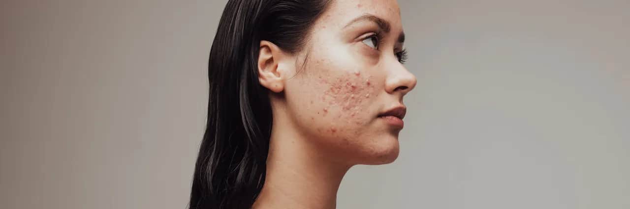 Reine Haut: Effektive Tipps gegen unreine Gesichtshaut & Pickel
