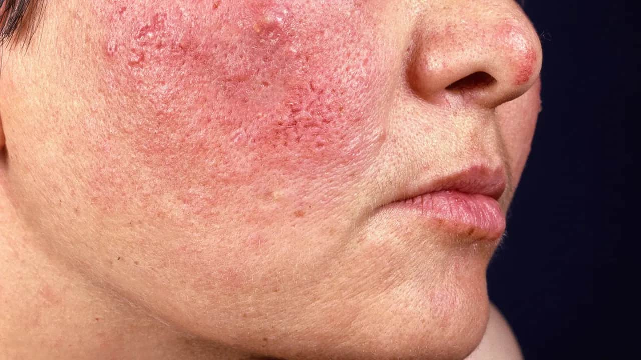 Rote Gesichtshaut? Finden Sie die perfekte Creme & Ursachen