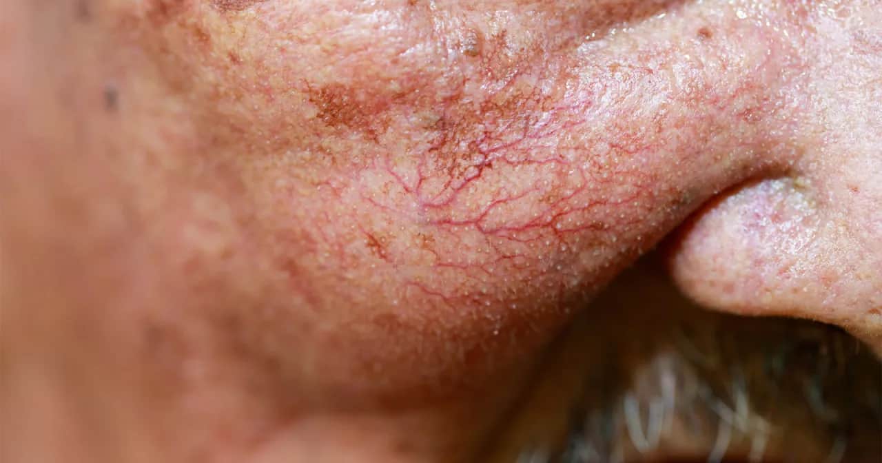 Couperose-Kosmetik: So beruhigen Sie rote Äderchen wirklich