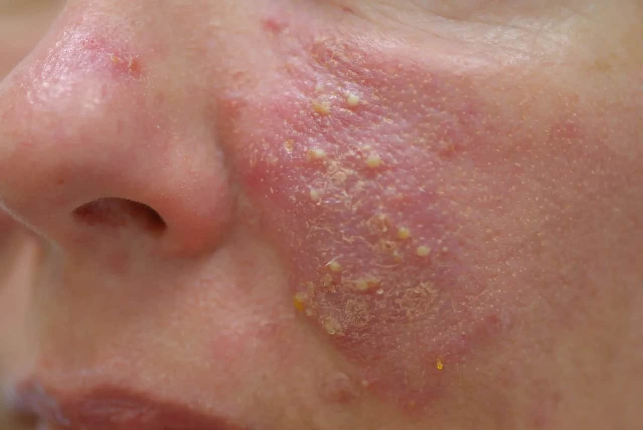 Rötungen im Gesicht: Was hilft wirklich gegen Couperose & Rosazea?